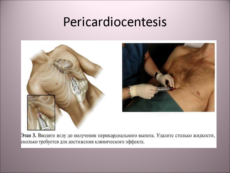 Pericardiocentesis